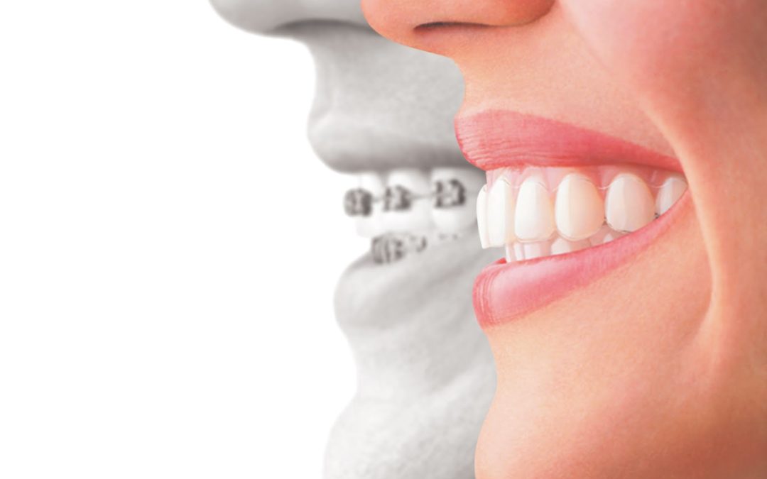 Ask Your Fort Worth, Weatherford, Granbury and Azle Dentist: What’s the difference between Invisalign and Metal Braces?
