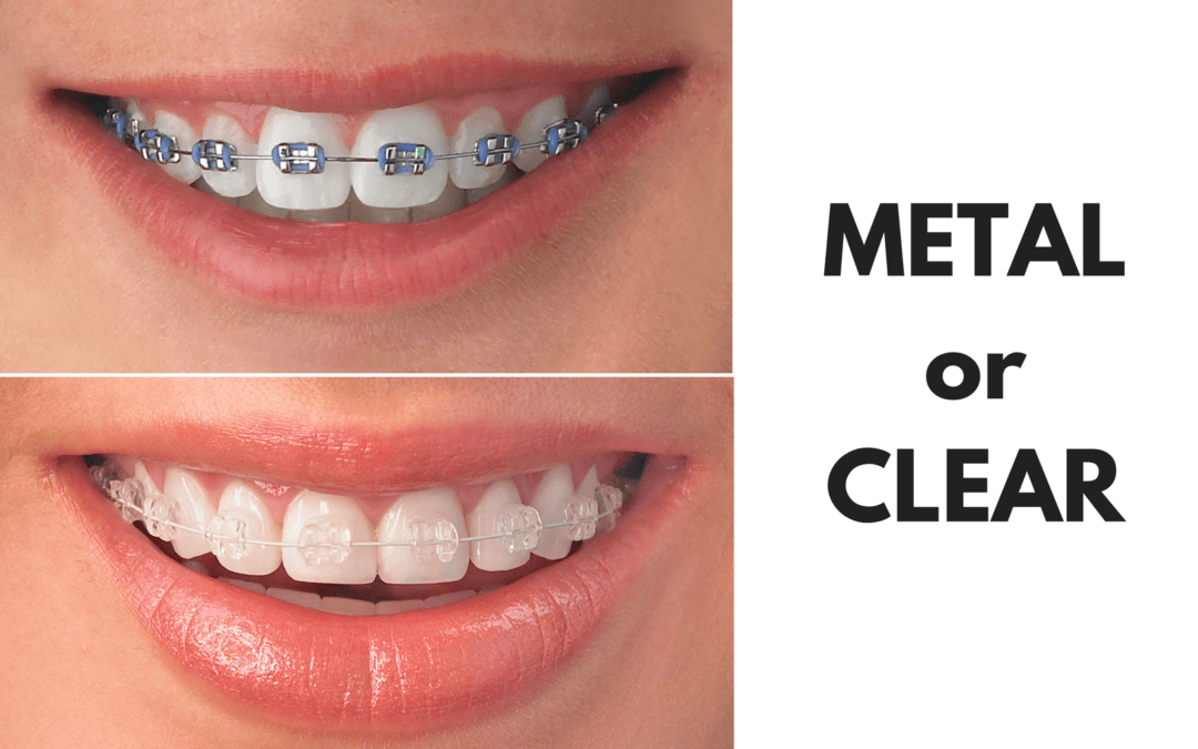 Ask Your Fort Worth Dentist: Should I Get Metal or Clear Braces?