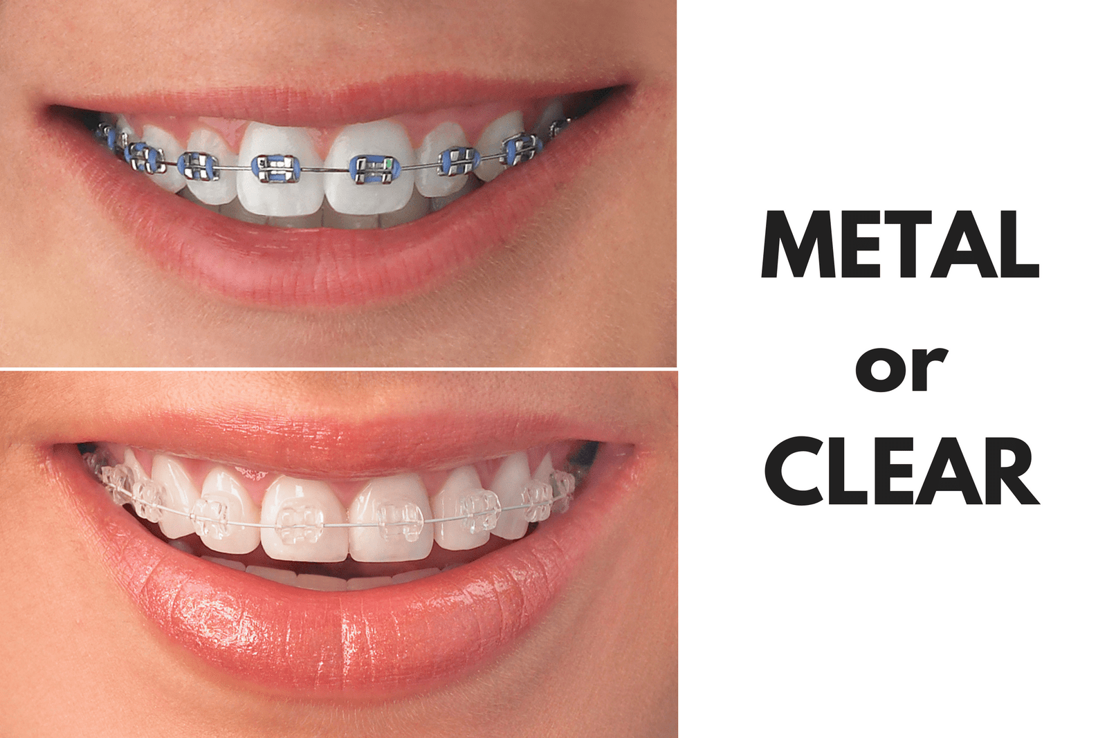 Ask Your Fort Worth Dentist: Should I Get Metal or Clear Braces