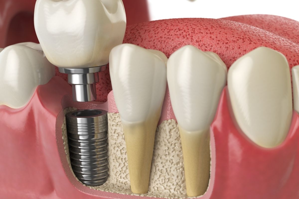 dental-implants