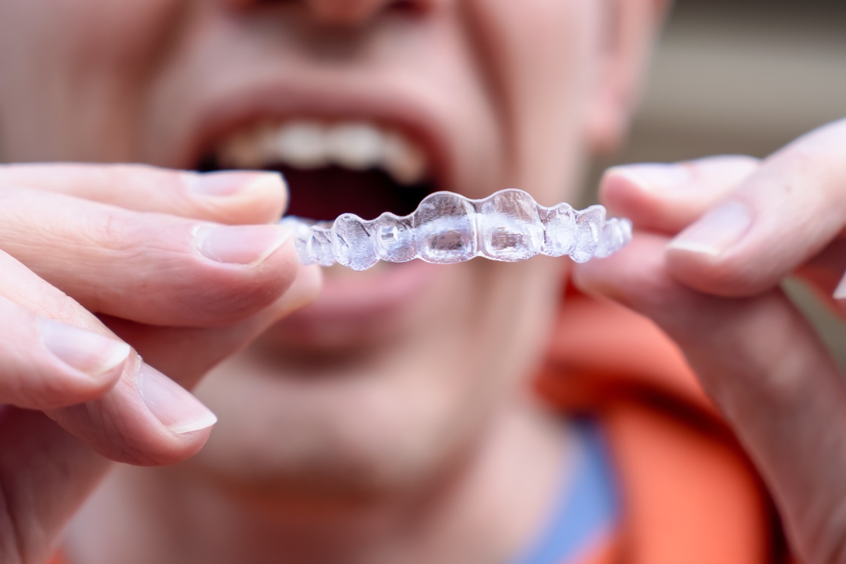Invisalign designed to straighten teeth